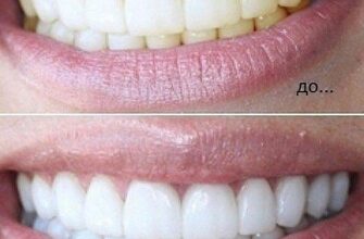 Натуральное отбеливание зубов