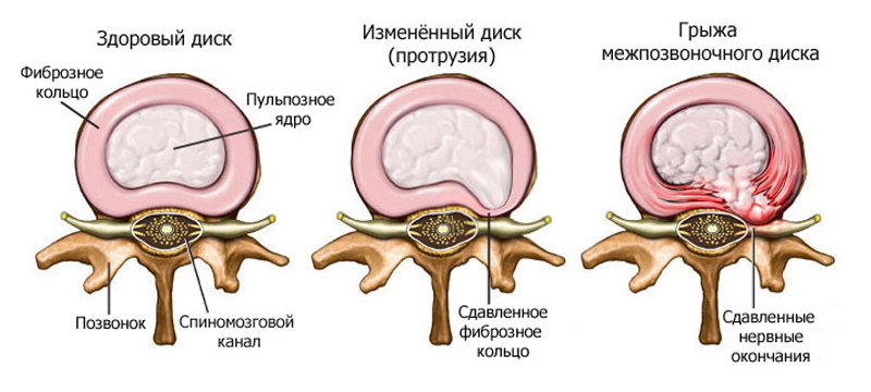 Как я победила межпозвоночную грыжу: прополисный холстик при грыже и протрузиях