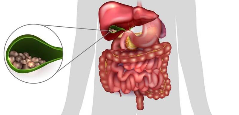 Холецистит – мука века: упражнения для усиления желчеотделения