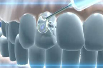 Наконец-то изобретена пожизненная пломба, которая в состоянии сама вылечить зуб!