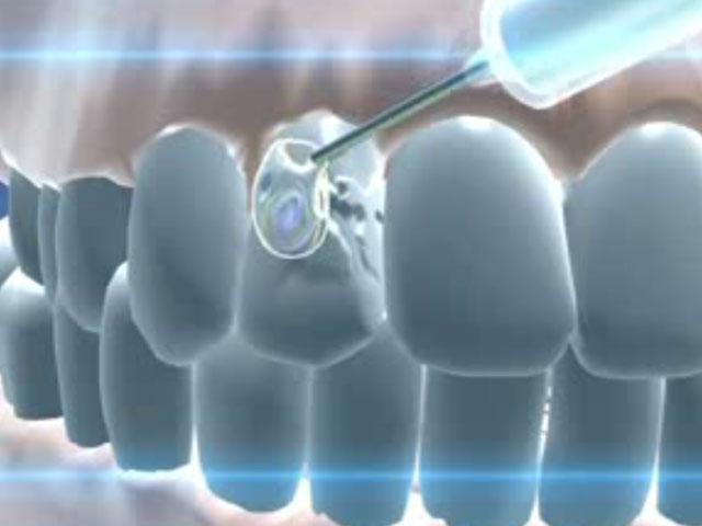 Наконец-то изобретена пожизненная пломба, которая в состоянии сама вылечить зуб!
