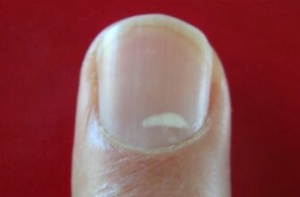 «Красная тревога»: Если вы видите это на ваших ногтях, немедленно обратитесь к врачу!